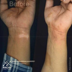Hand Vitiligo Treatment
