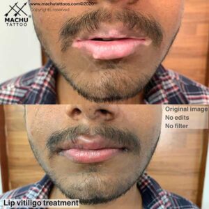 Lip Vitiligo Treatment